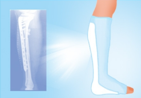 Bioluminescent Polymer Splint | Medical Polymer Splint | Orthopedic Splint